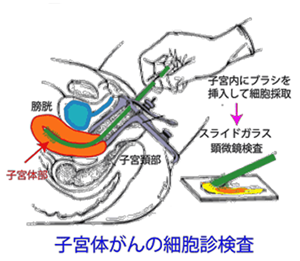 検診 子宮 ん 体 が 子宮体がん｜公益社団法人 日本産科婦人科学会