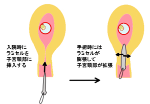 ラミセル