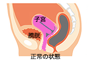 骨盤臓器脱