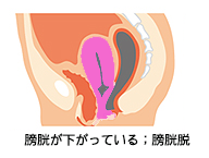 骨盤臓器脱