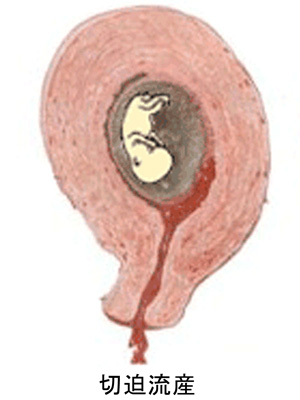 妊娠初期 血の塊 妊娠継続