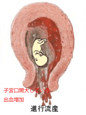 妊娠中の出血